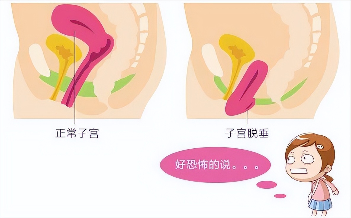 女人67岁得了子宫癌有什么症状呢,55岁妇女子宫脱垂最好解决办法