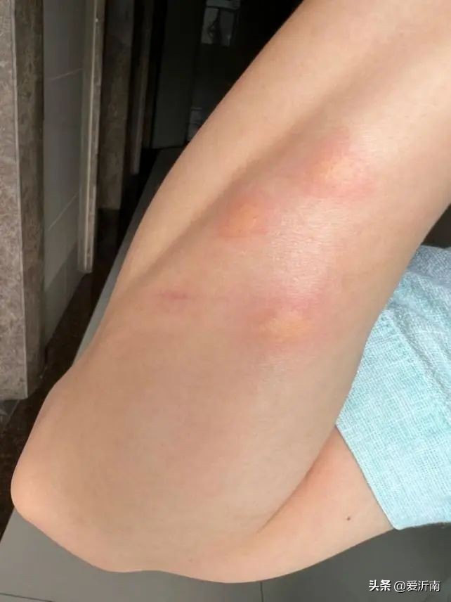 身上突然痒是蚊子吗,身上无缘无故的痒到处长蚊子大包