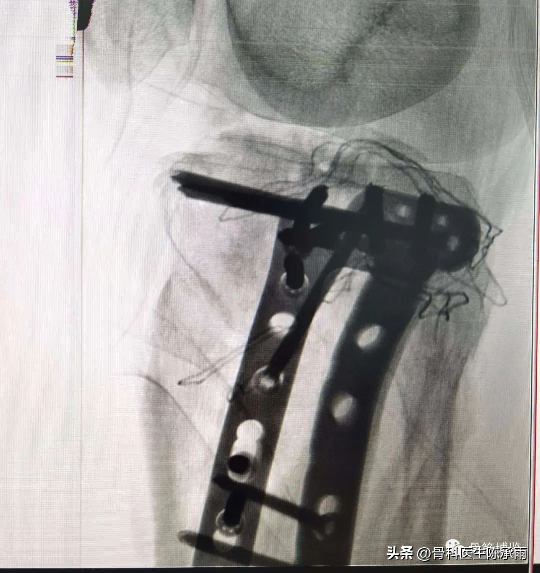 膝关节胫骨平台骨折,最近胫骨平台骨折视频