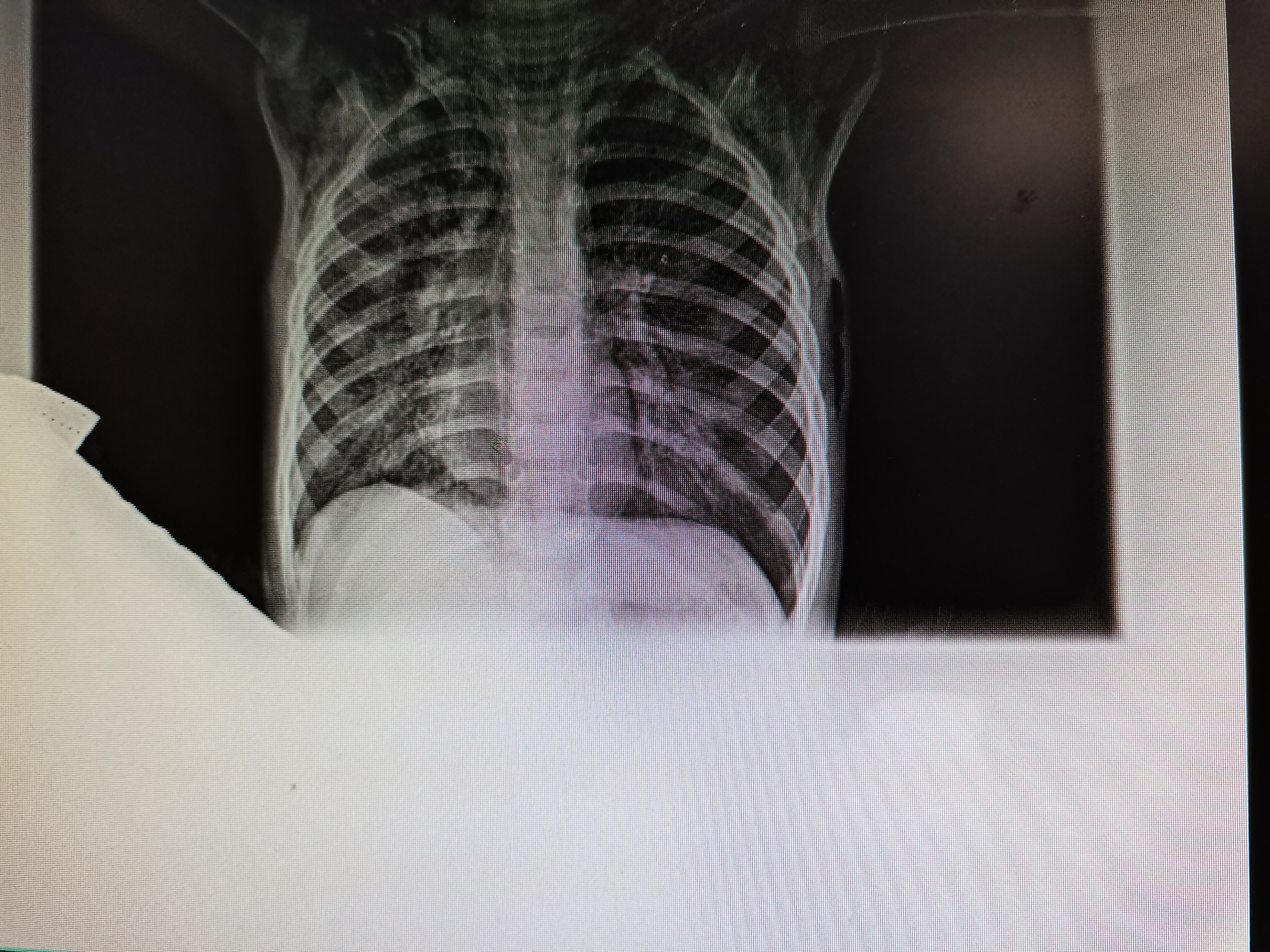 一颗花生米差点要了孩子的命,一颗花生引发的悲剧