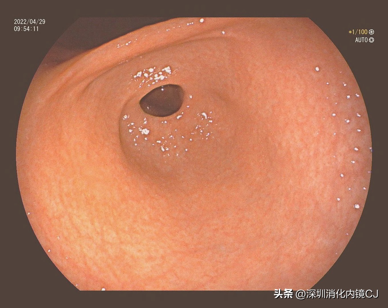 幽门螺旋杆菌感染胃粘膜表现,没有幽门杆菌但是胃窦鸡皮样改变