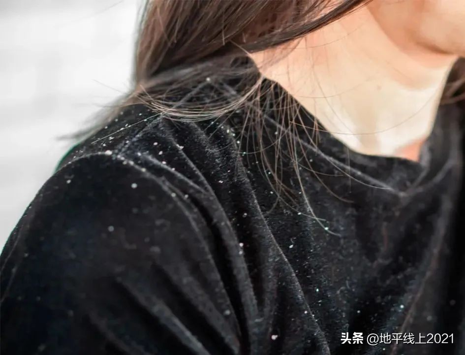 天天洗头头屑多是什么原因引起的,头发不天天洗为什么就会有头屑