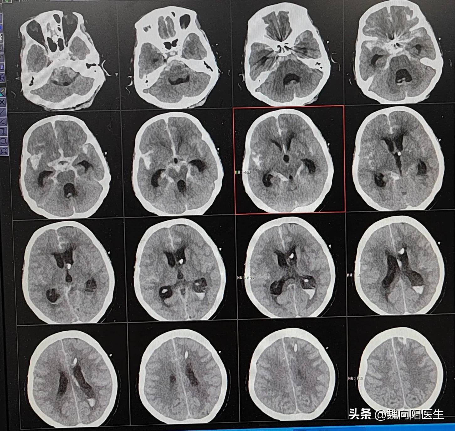 蛛网膜下腔出血简单确诊,蛛网膜下腔出血最有效的检查方法
