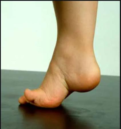 先天性马蹄足,先天性马蹄足矫形方法