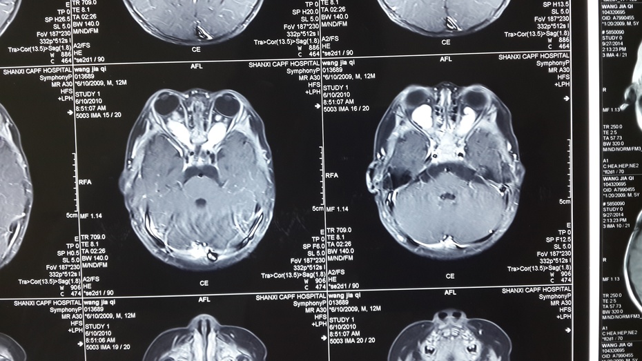 贺晓生教授胶质瘤的手术治疗实例,贺晓生神经外科教授视频