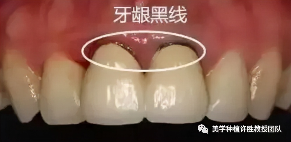 烤瓷牙和全瓷牙的区别及价格,烤瓷牙与全瓷牙价格相差多少