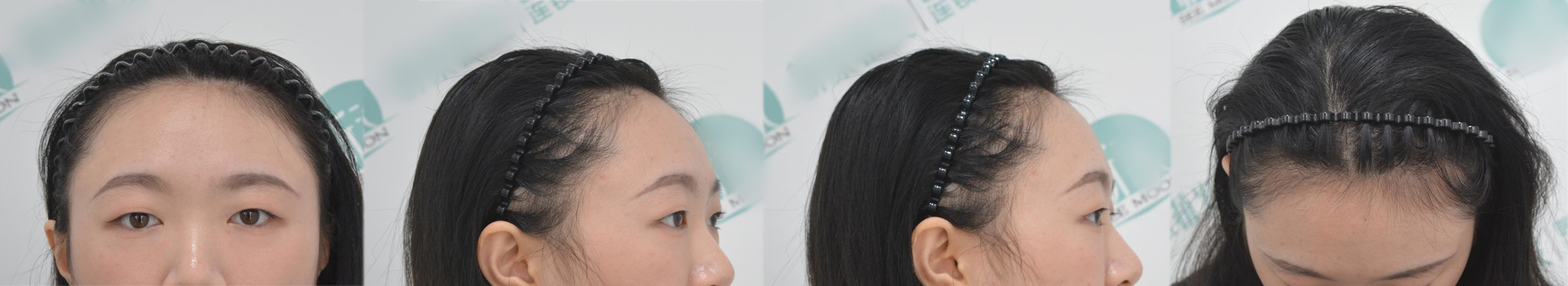 植发手术后恢复全过程,植发手术全过程详解