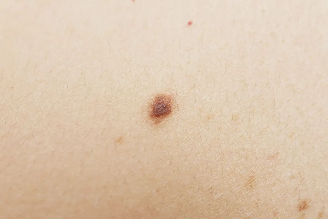 痣的旁边长了几个小痣是癌变吗,痣的变化和身体健康的关系