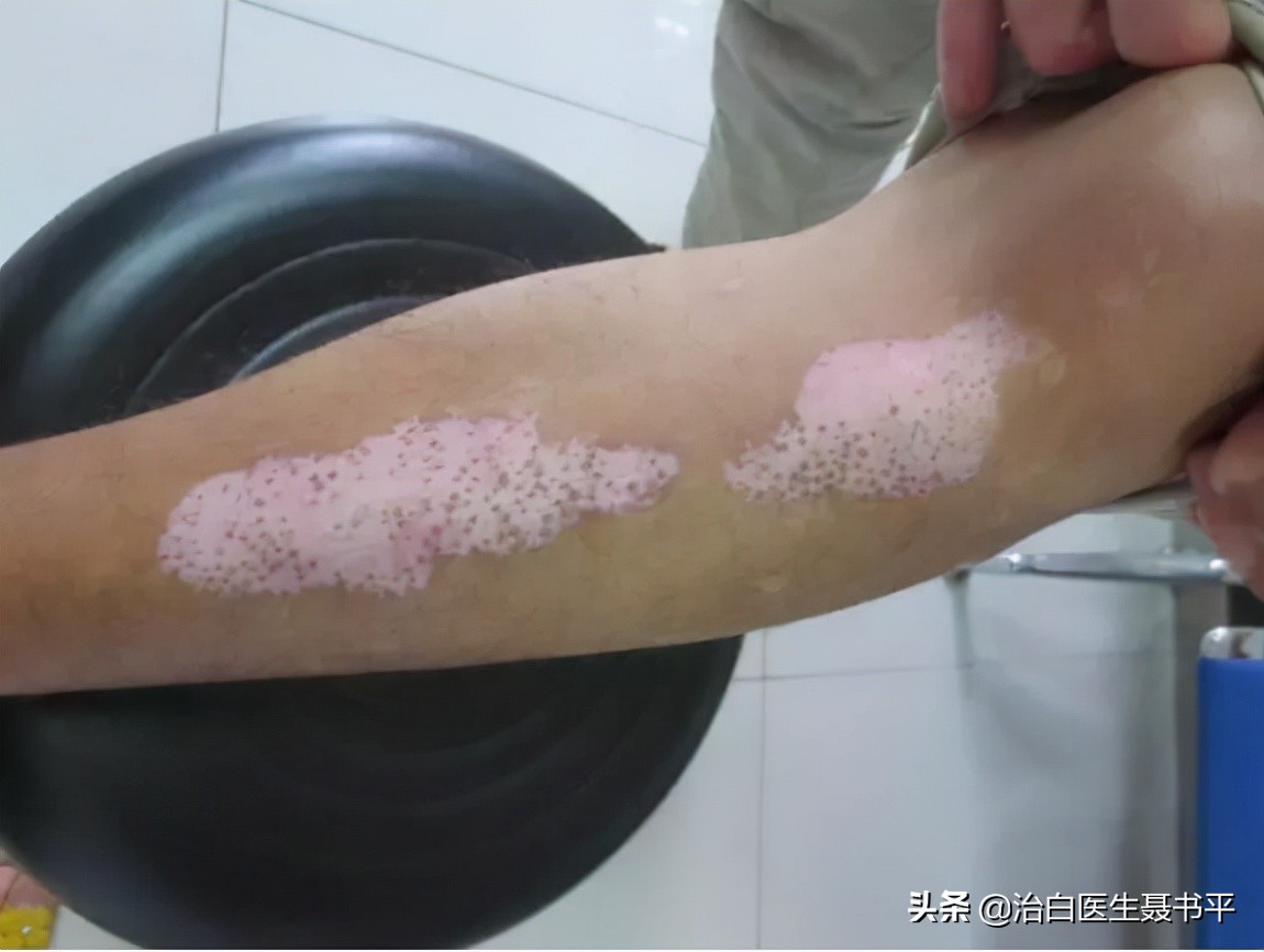 口腔粘膜白斑好转后粘膜变黑,白斑变黑能恢复