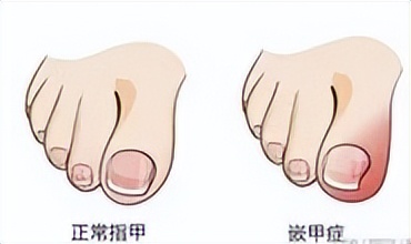 嵌甲炎拔甲怎么治疗,嵌甲疼痛用什么药膏