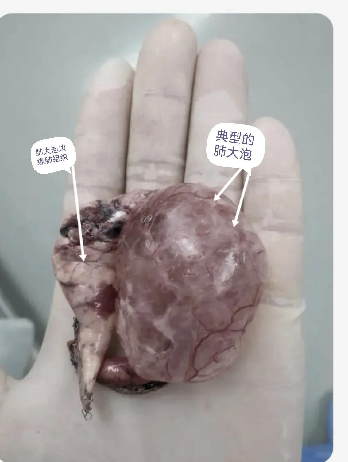 肺大泡产生的原因及治疗方案,肺大泡怎么治疗断根