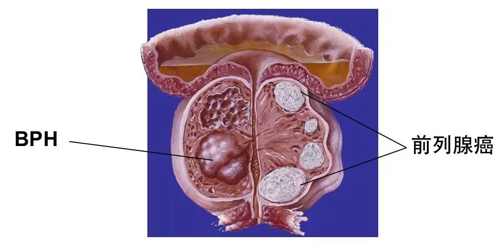 得了前列腺炎一辈子就完了,得了前列腺炎还能生孩子吗