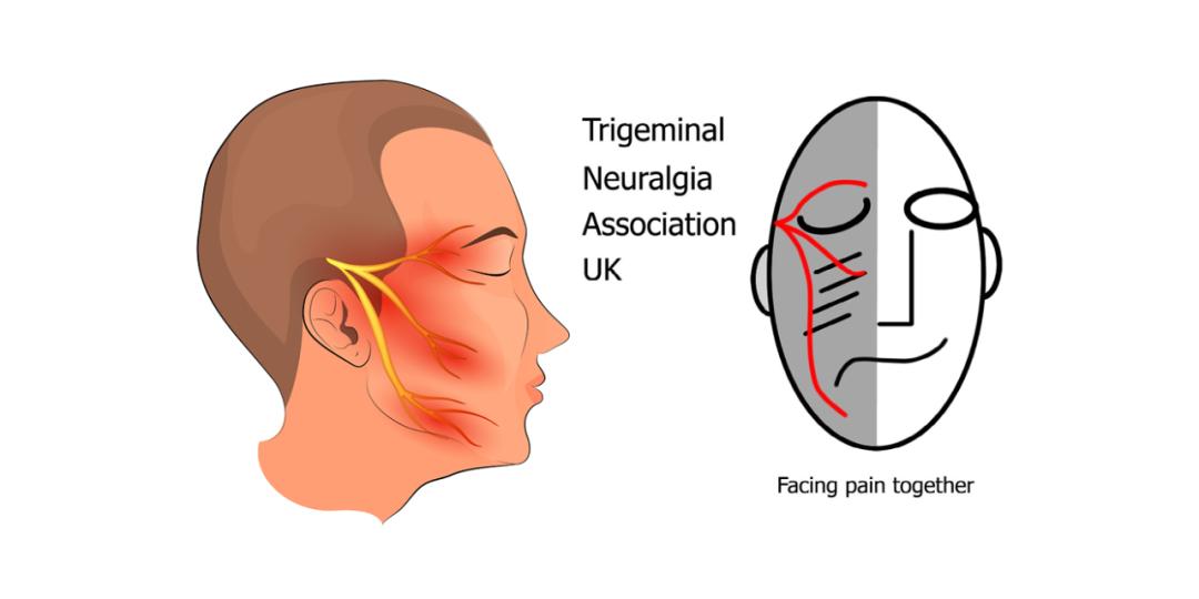 卡马西平治疗三叉神经痛多久停药,三叉神经痛吃什么药能彻底治愈