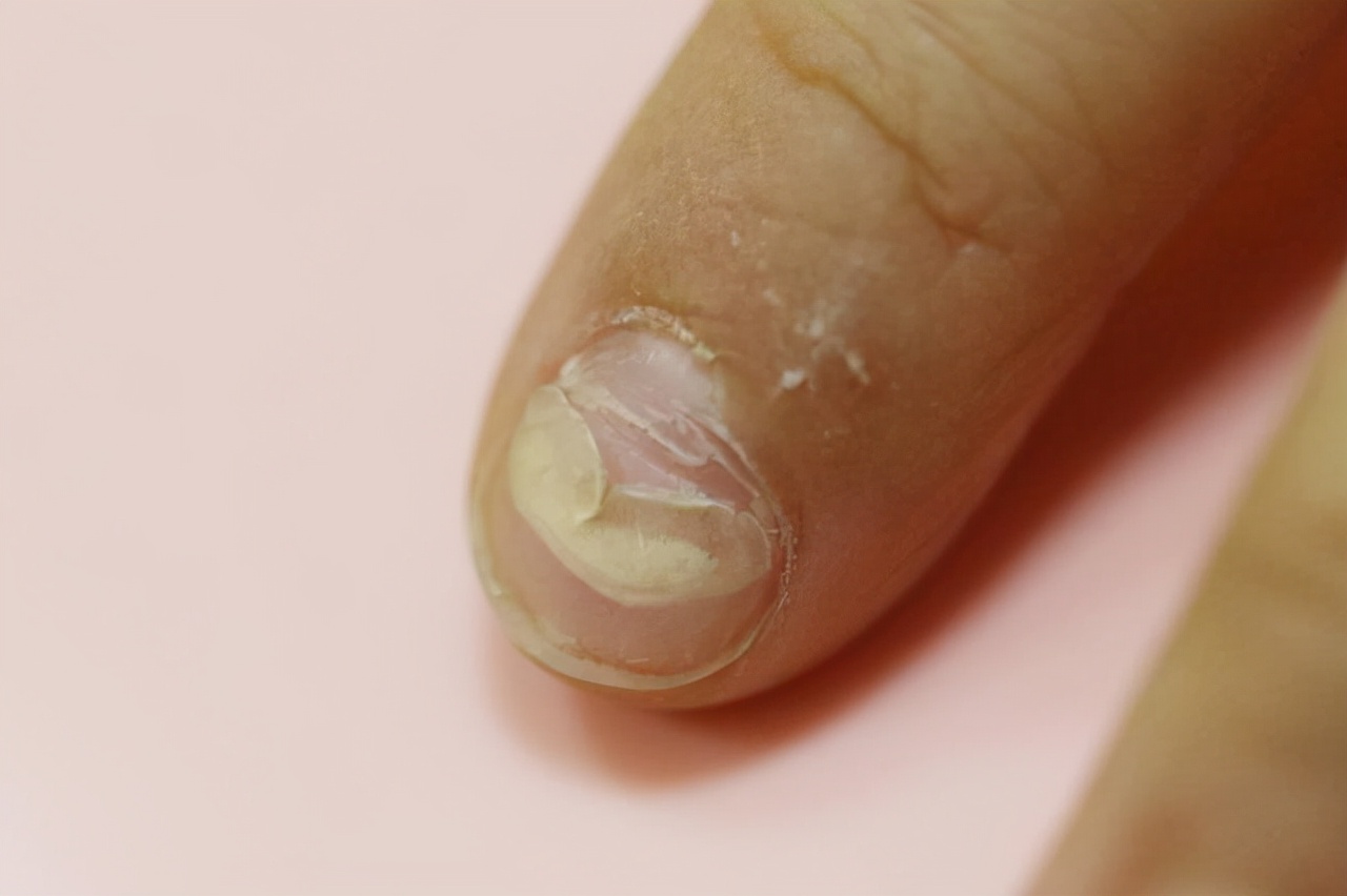 十岁孩子指甲上有竖纹是怎么回事,手指甲出现竖纹是身体哪里的原因