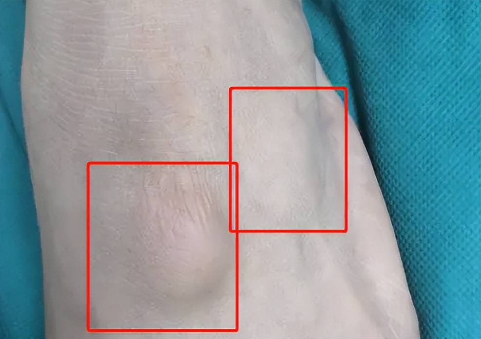 骨科腱鞘囊肿有什么症状啊,腱鞘囊肿会压迫血管的症状