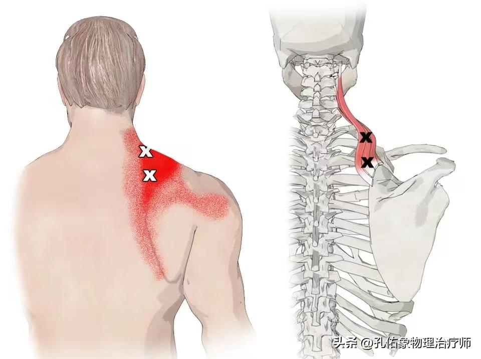 后背疼痛筋膜炎最好的恢复办法,后背肌筋膜炎全身不舒服