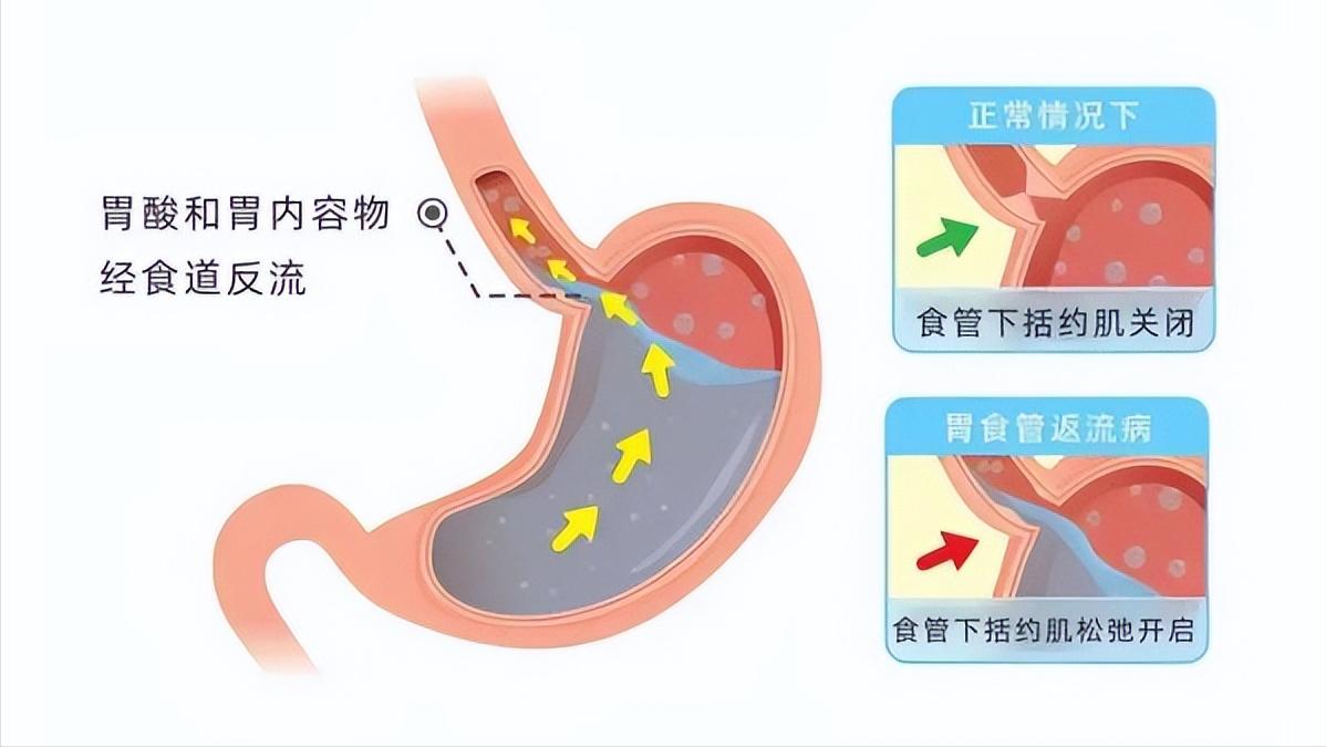 胃酸过多奥美拉唑吃多久见效,奥美拉唑治胃酸长期服有副作用吗