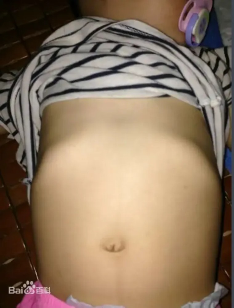 孩子肋骨外翻有必要矫正吗,孩子肋骨外翻正常吗需要补钙吗