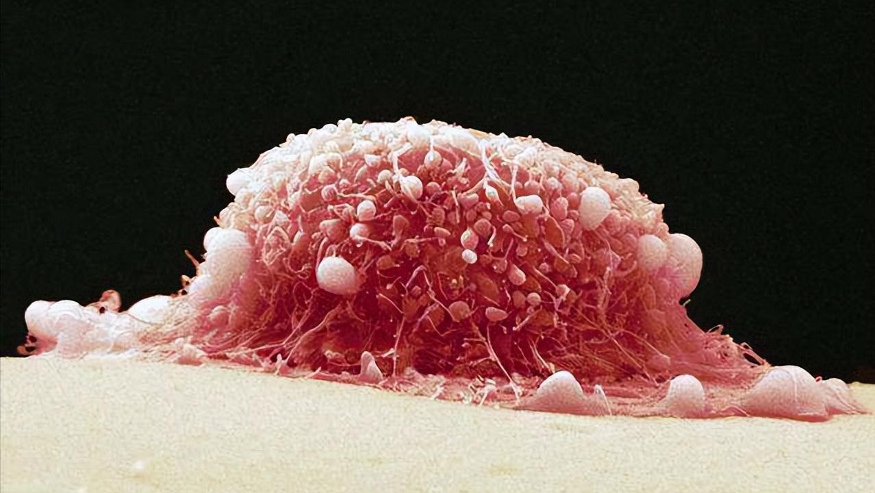 一度宫颈糜烂严重吗需要怎么治疗,有一点轻微宫颈糜烂要不要紧