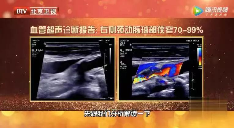 2年没复查结节竟然变成了癌症,息肉化验是癌前病变怎么办