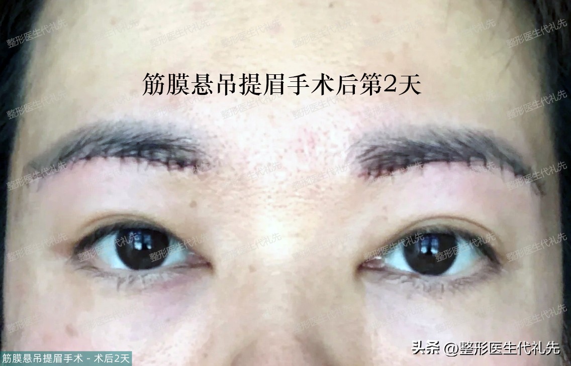 45岁女性做提眉手术多久能恢复,40岁做提眉手术的视频