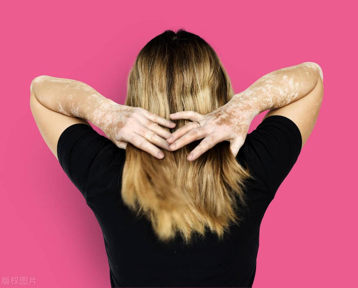 眼皮白癜风怎样治疗好,眼部白癜风用激光治疗效果如何