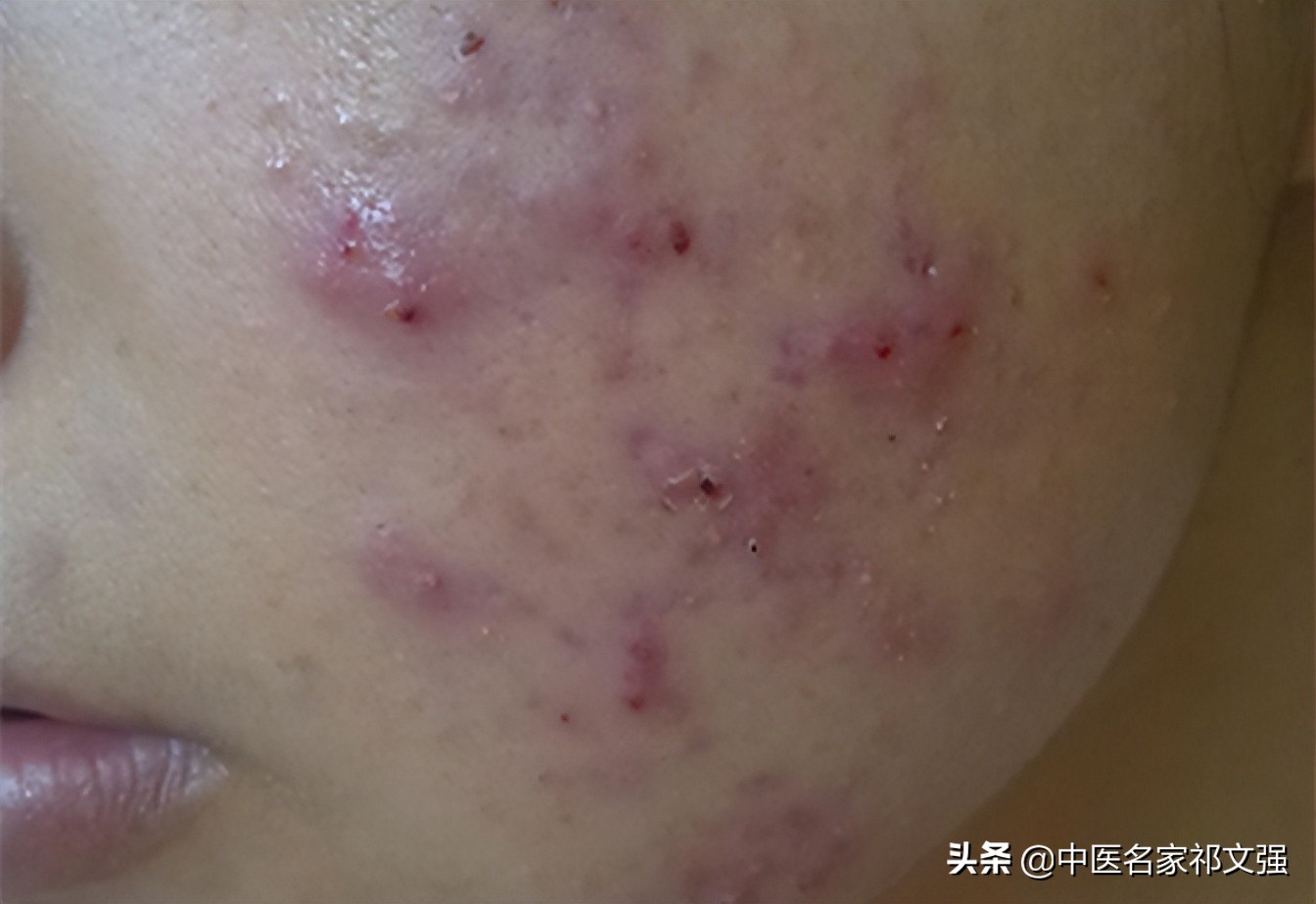 中医治脓疮偏方,火钳子疮中医治法