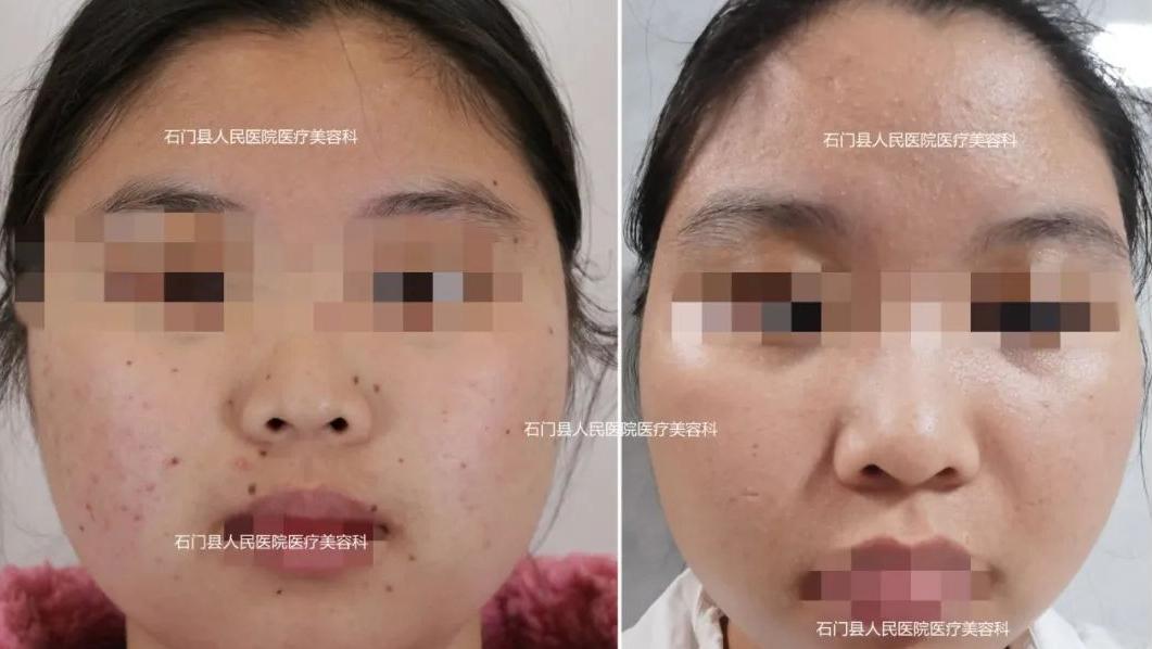 有痣人士点痣要慎重,肉痣怎么点痣最靠谱