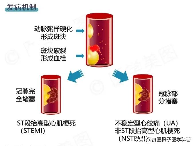 足球名将王涛，演员陆树铭因心梗去世，心梗越来越年轻化？