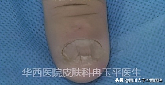 得了灰指甲是指甲变灰吗,灰指甲增厚变黑是灰指甲吗