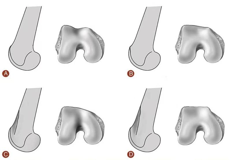 髌骨骨折评估,髌骨上下滑动评估什么内容