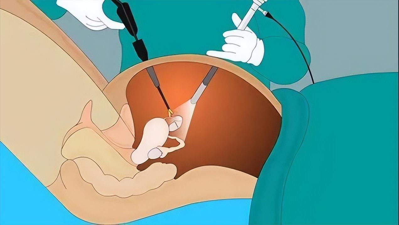 女子头晕胸闷,以为心肺不好,医生看到她的指甲怀疑子宫肌瘤