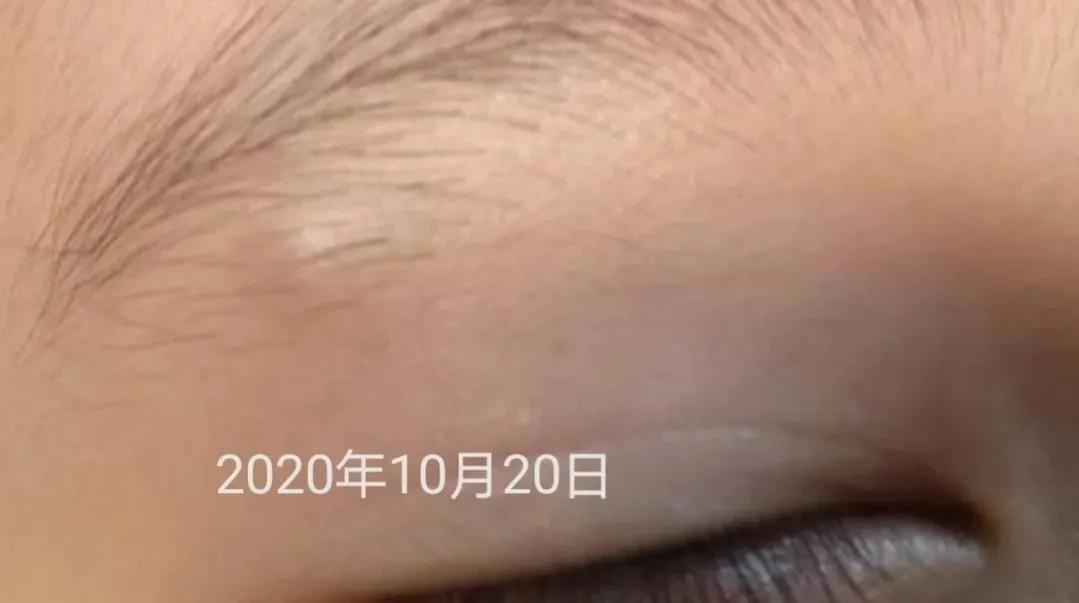 孩子头部皮脂腺囊肿能保守治疗吗,孩子面部皮脂腺囊肿