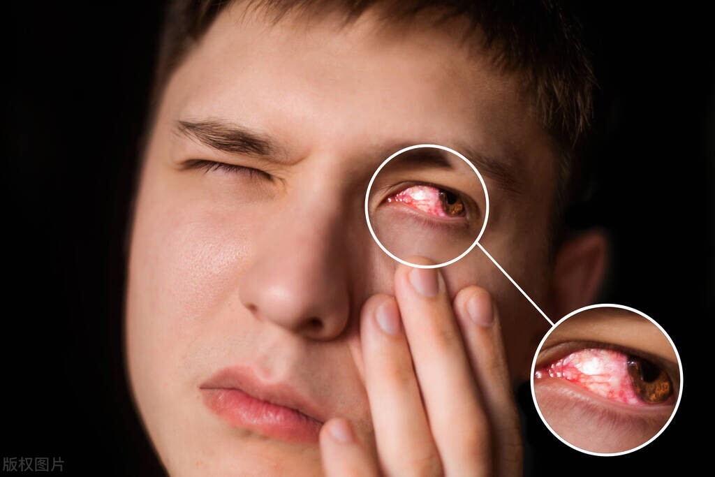 眼睛肿流黄色液体,眼睛肿了为什么会流黄色东西