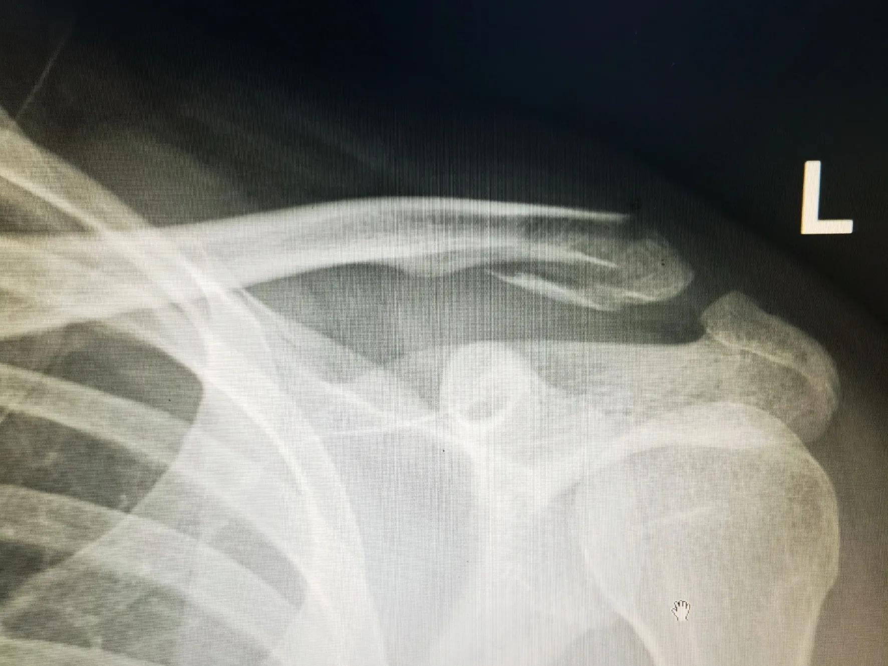 骨折手术细菌感染严重吗,骨折手术感染早期症状