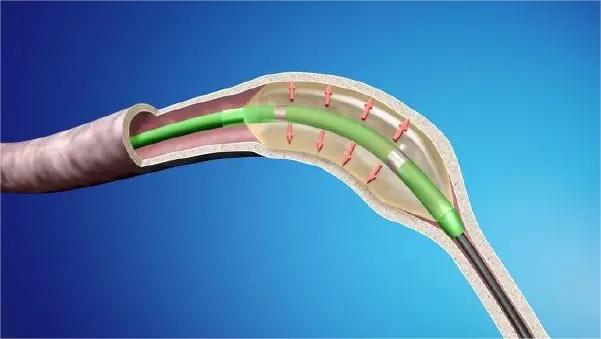 输尿管狭窄什么引起的,导致输尿管狭窄的原因有哪些