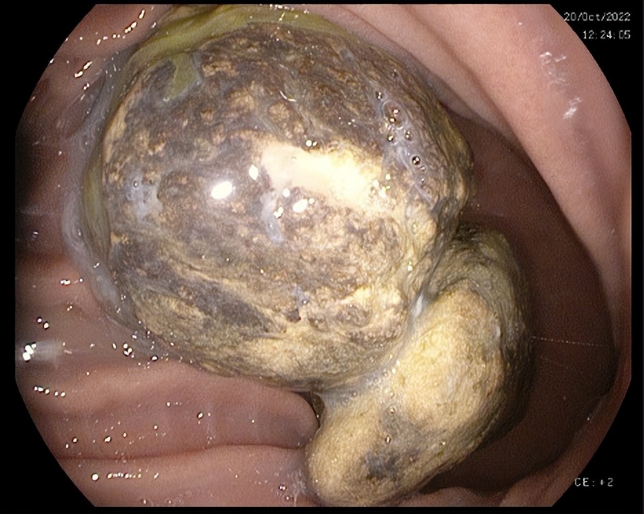 63岁大爷胃里长了结石,大爷胃病医生开一堆药后续