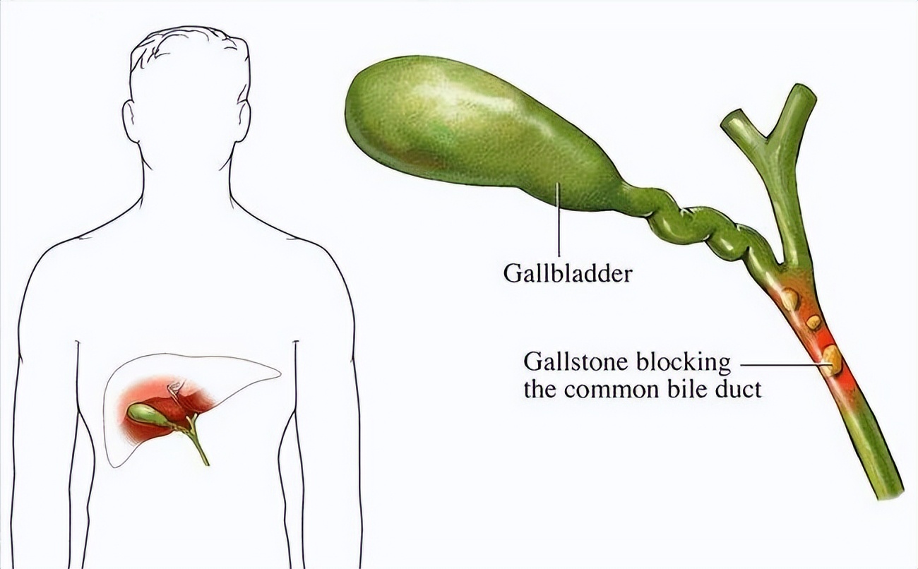 为什么胆有结石必须摘了,胆结石医生为什么都建议割胆