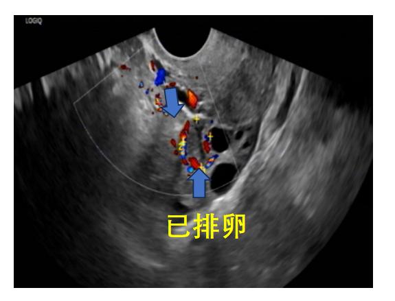 助您好孕——B超监测排卵不可不知道的细节