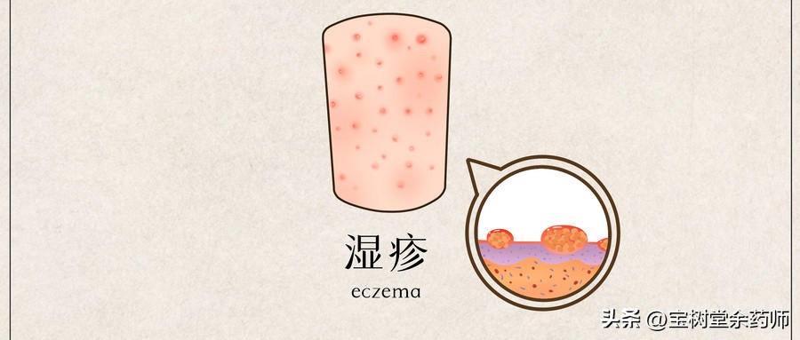 湿疹如果不治疗可以自愈吗,屁股湿疹最简单的自愈方法