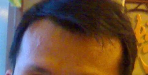 雄脱植发的亲身经历和感受,16000字讲述植发真实感受