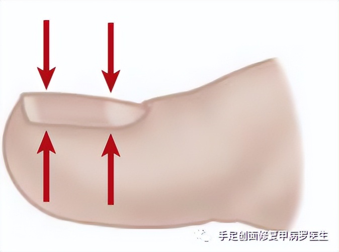 不要等孩子出了问题才重视,孩子得了甲沟炎怎么自己治疗