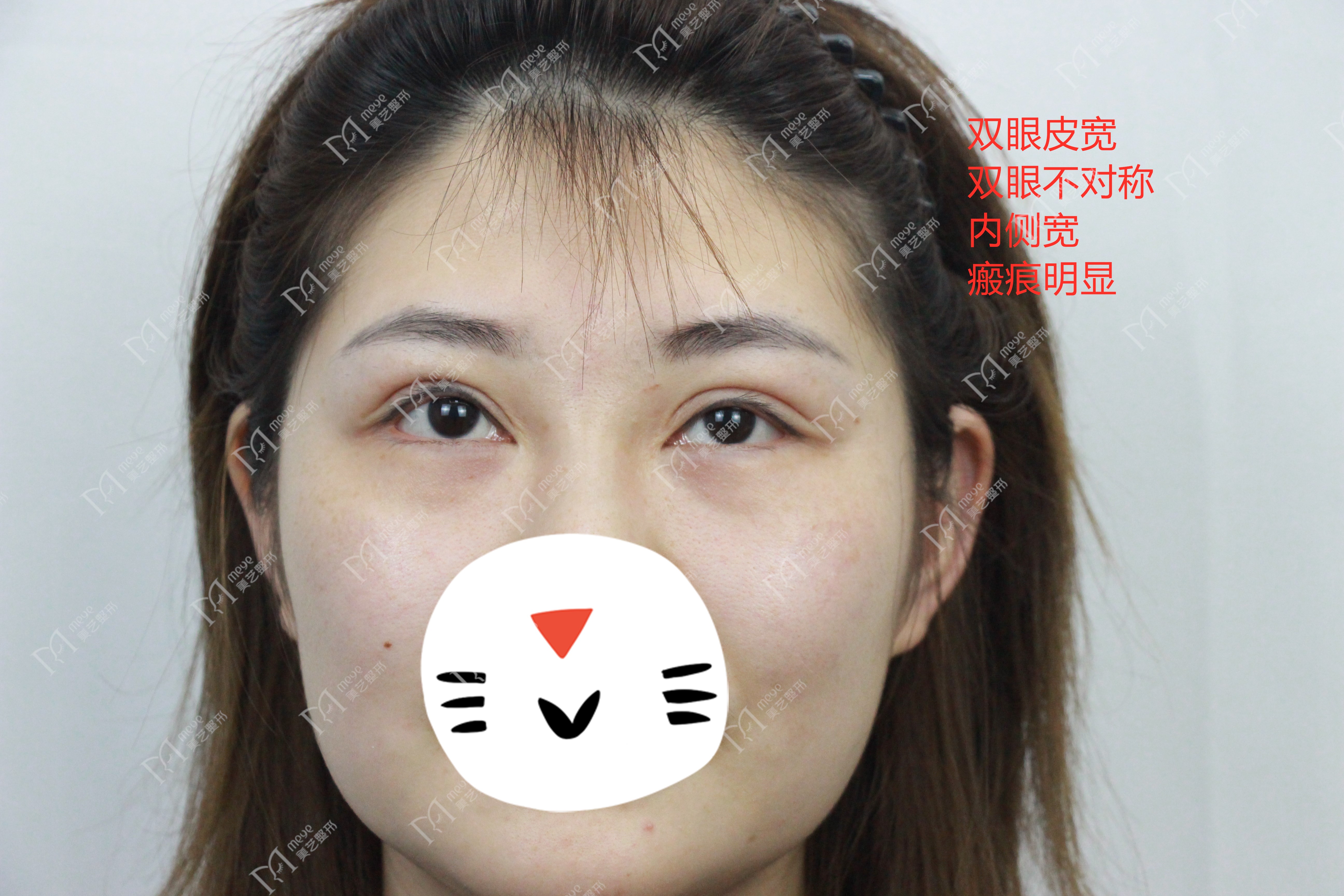 双眼皮太宽了能修复吗该怎么修复,双眼皮割窄了怎么修复宽