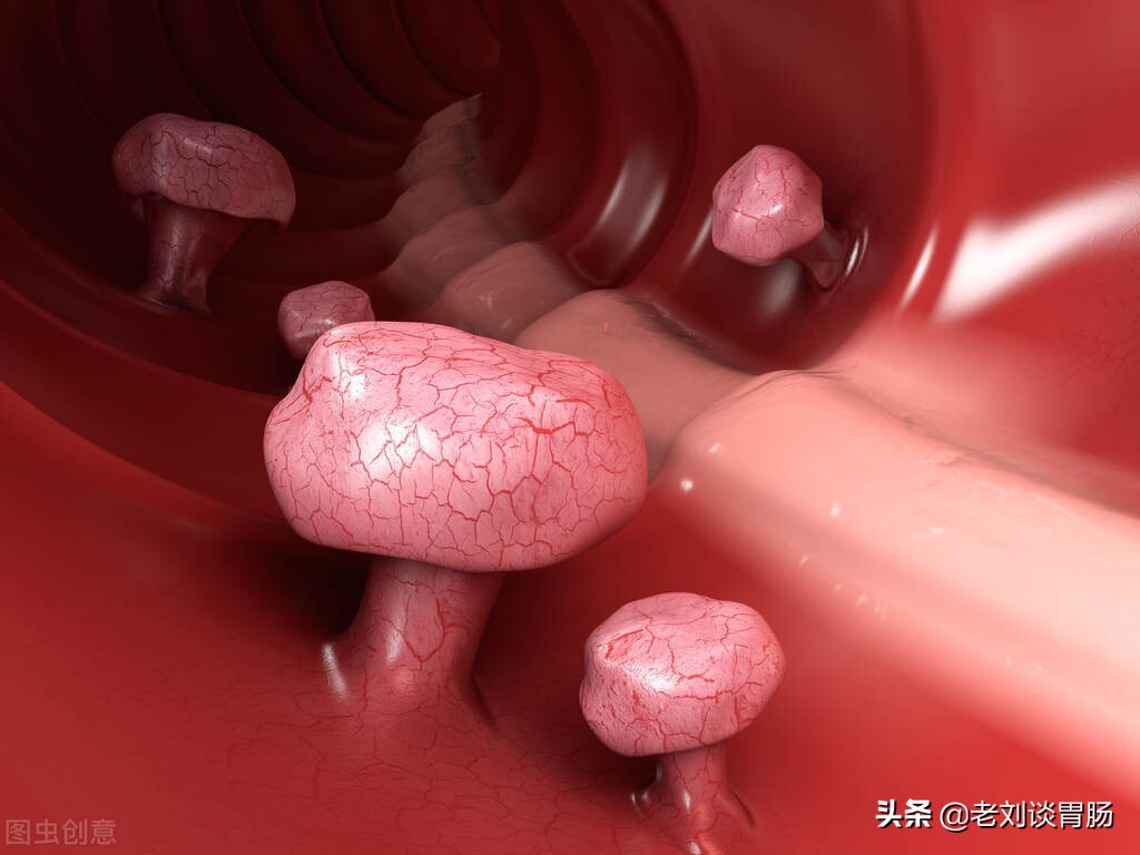 肠镜检查有多发性肠息肉,肠镜检查报告单怎么看肠息肉大小