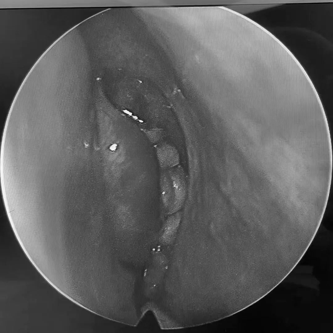 女子牙疼一周,女子牙痛用止痛药
