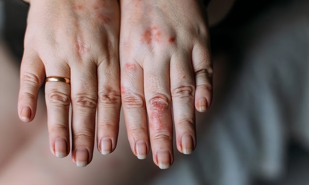 湿疹很痒挠破了是血咋治,湿疹反复挠皮肤变硬