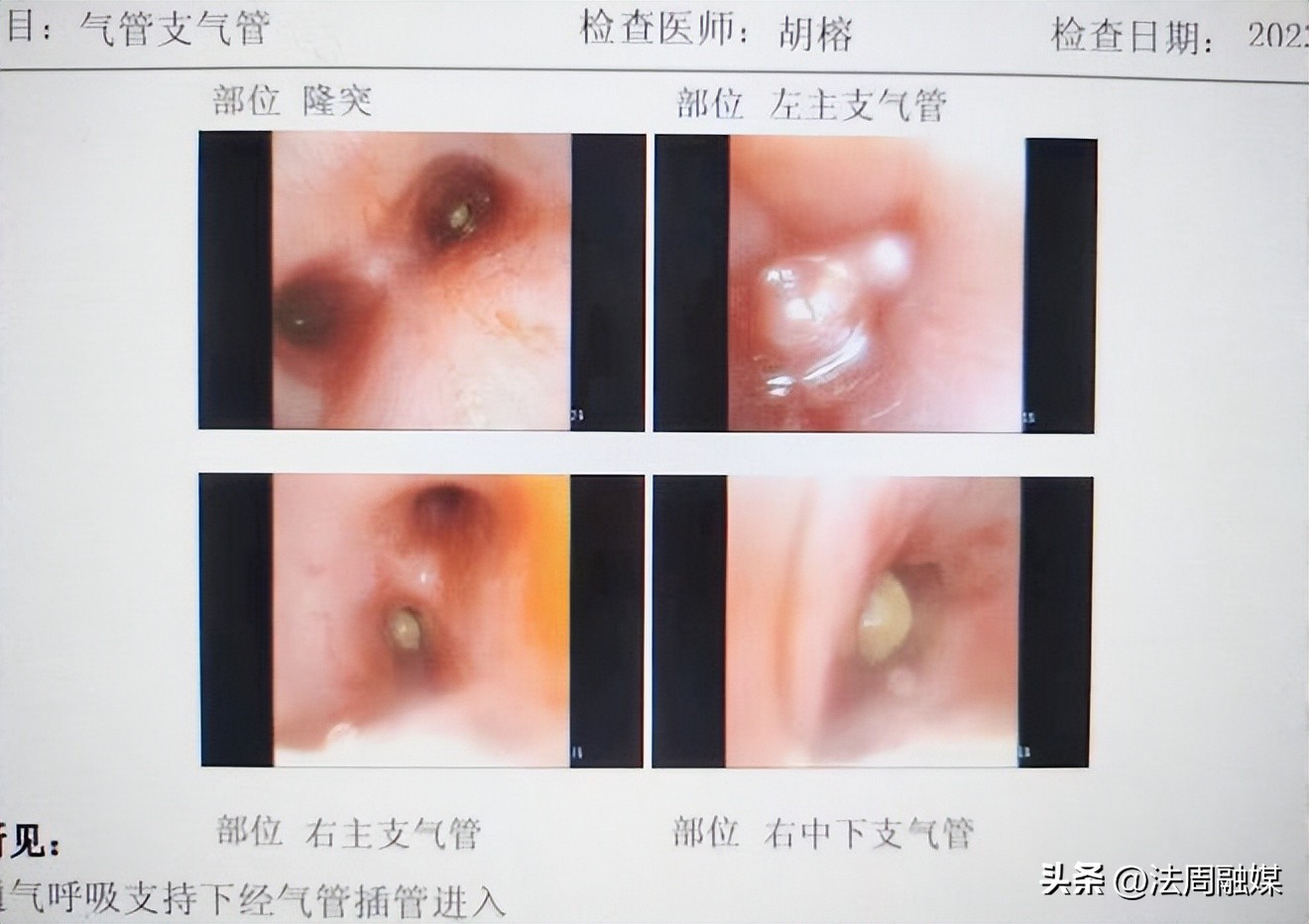 孩子坚果卡喉致死,婴幼儿吃坚果卡喉咙案例