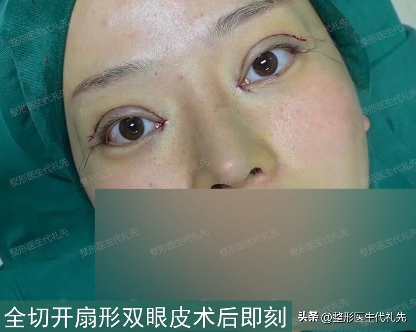 43岁女士全切开扇形双眼皮,术前术后高清照片细节对比,变化很大