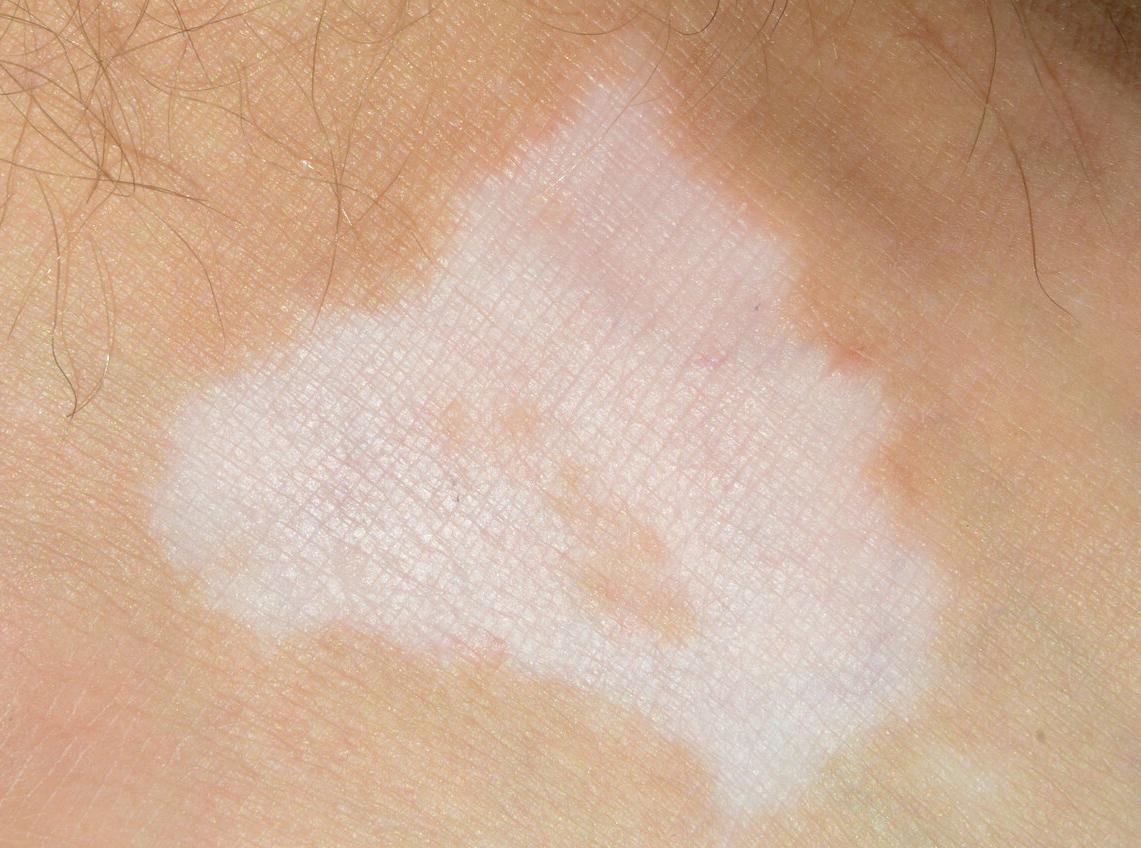 稳定期的白斑怎样快速复色,白斑复色成功