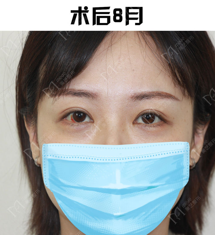 双眼皮内双和外双哪个好看,双眼皮贴内双变外双